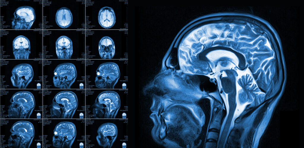 Magnetic resonance imaging of the brain